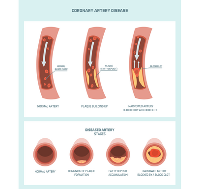 Heart attack: causes and warning signs • HRI