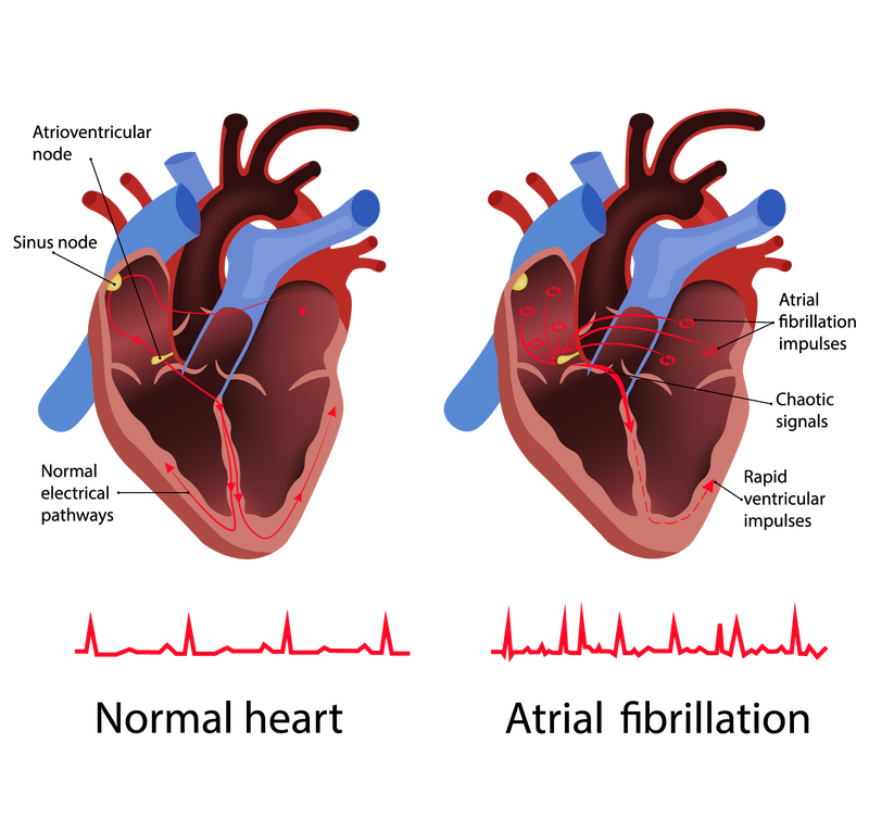 Atrial fibrillation: irregular heartbeat • HRI